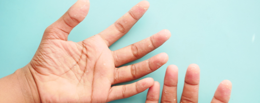 Ozonoterapia – adjuvant natural în bolile autoimune: lupus, poliartrită, psoriazis