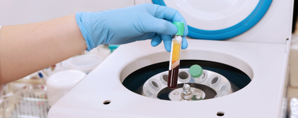 Infiltrațiile cu plasmă îmbogățită cu trombocite (PRP) – regenerare naturală